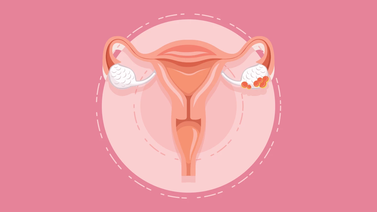 😮 ¿Qué es el Síndrome de Ovario Poliquístico? ¡Descúbrelo aquí!