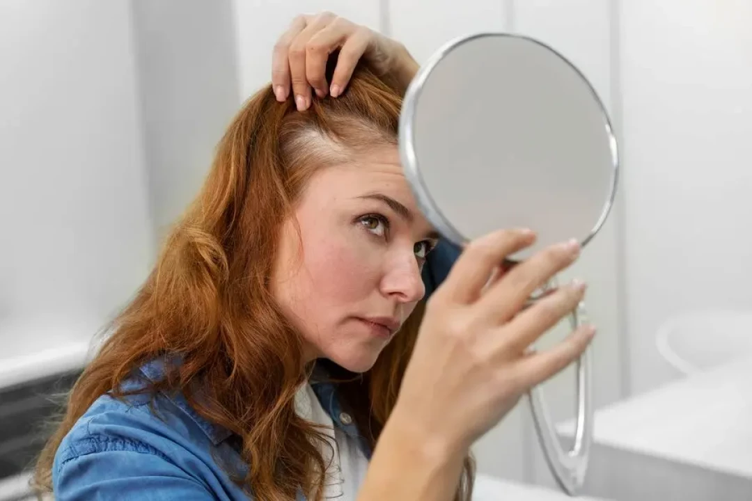 ¿Qué es la alopecia androgénica y como se cura?